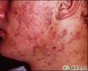 Acne cística no rosto