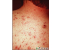Acne vulgar nas costas
