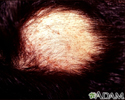 Alopecia areata com pústulas
