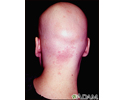 Alopecia totalis - visão posterior da cabeça
