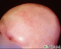 Alopecia totalis - visão frontal da cabeça