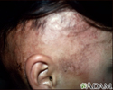 Alopecia, em tratamento