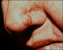 Câncer de pele, carcinoma basocelular - nariz