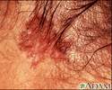 Câncer de pele, carcinoma basocelular - pigmentado