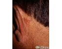 Câncer de pele, carcinoma basocelular - atrás da orelha