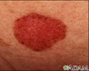 Câncer de pele, carcinoma basocelular - disseminação