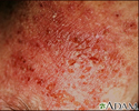 Imagem em close de dermatite de contato alérgica