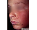 Dermatite de contato na bochecha