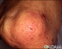 Dermatite herpetiforme no joelho