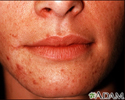 Dermatite perioral