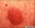 Dermatite de contato pustulosa