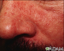 Dermatite seborreica - imagem em close