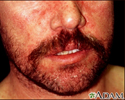 Dermatite seborreica no rosto