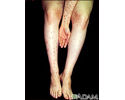 Dermatite, herpetiforme no braço e nas pernas