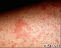 Eczema, atópico - imagem em close