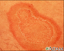 Eritema anular centrífugo - imagem aproximada