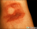 Fixed drug eruption, bullous