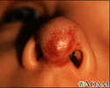 Hemangioma no rosto (nariz)