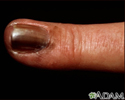 Câncer de pele, melanoma nas unhas