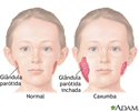 Caxumba (parotidite)