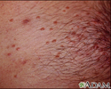 Molusco contagioso no peito