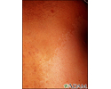 Neurofibromatose, mancha café com leite gigante