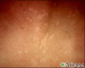 Tinea versicolor - aproximação
