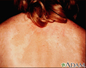 Tinea versicolor nas costas