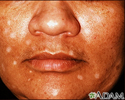 Vitiligo induzido por drogas