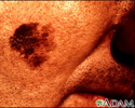 Câncer de pele, imagem aproximada de melanoma maligno lentigo