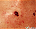 Câncer de pele, imagem aproximada de melanoma de nível IV