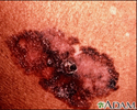 Câncer de pele, propagação superficial de melanoma