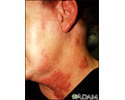 Herpes-zóster (cobreiro) no pescoço e na bochecha