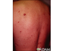 Sarcoma de Kaposi nas costas
