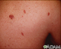 Sarcoma de Kaposi - imagem detalhada