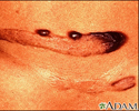 Queloide pigmentado