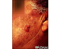 Carcinoma das células escamosas - invasivo