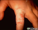 Tinha, tinea manuum no dedo