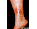 Dermatite de estase na perna