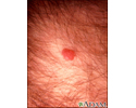 Sarcoma de Kaposi - perianal