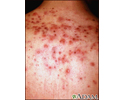 Acne - imagem aproximada de cistos nas costas