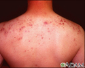 Acne cística nas costas