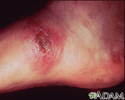 Leishmania panamensis no pé