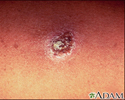 Leishmania panamensis - imagem detalhada