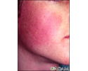 Queratose pilar rubra faceii
