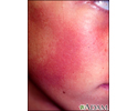 Queratose pilar rubra faceii