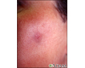 Fixed drug eruption on the cheek