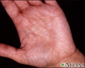 Hiperlinearidade em dermatite atópica