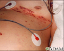 Herpes-zóster (cobreiro) disseminado