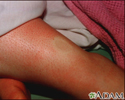 Edema depressível nas pernas